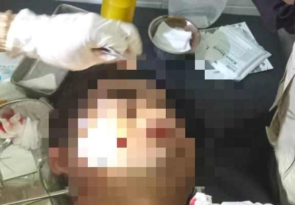 Niat Menonton Singo Ulung, Pengunjung Wisata Pemandian Tasnan Bondowoso Alami Luka Robek
